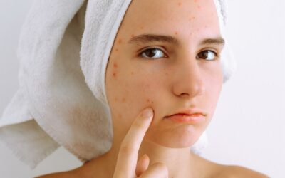 How to Combat Summer Acne: Skincare Strategies and Formulation Guide