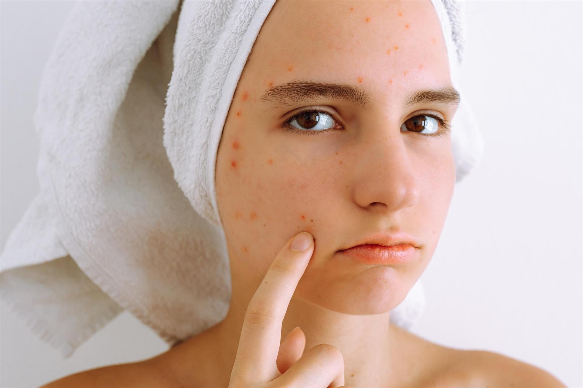 How To Combat Summer Acne Skincare Strategies And Formulation Guide